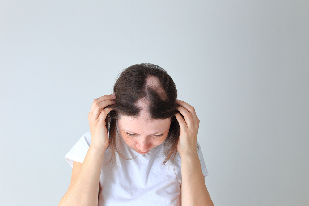 Alopecia Areata