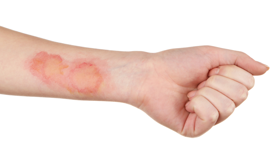 Skin/ Hair Infection Treatment at Ozone Care Clinic